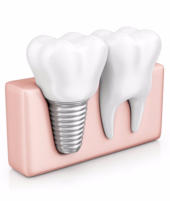 Dental Implants, Panorama Oral Surgery