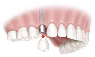 Dental Implants | Winnipeg